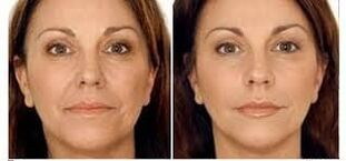 antes e despois