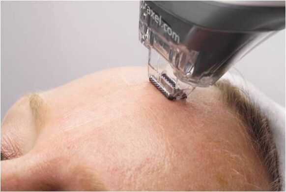 Procedemento de peeling para rexuvenecer a pel facial